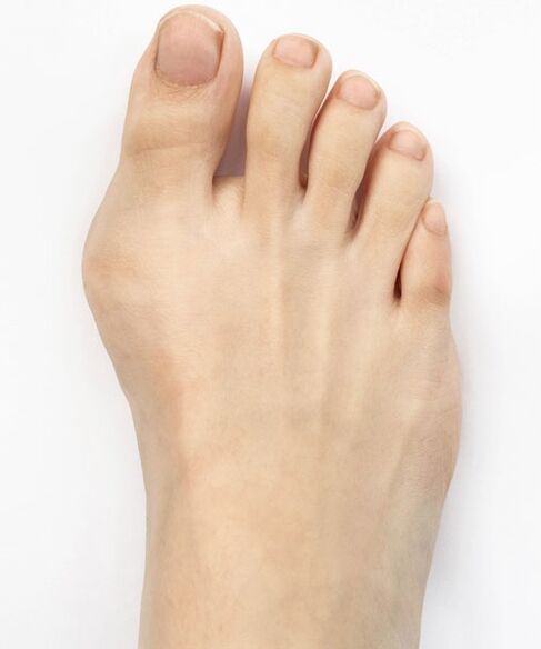 Bunion before using Hondro Sol Valgus spray
