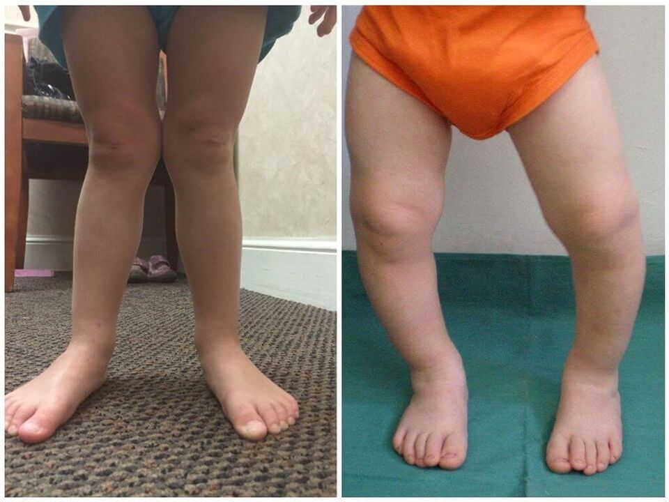 Causes of valgus deformation in children
