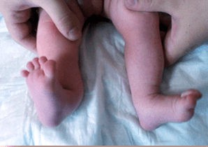 Symptoms of valgus deformation in children