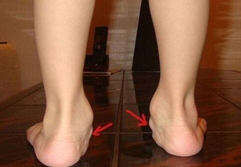 Deformation of children's feet