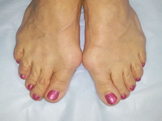 Hallux valgus deformity of foot