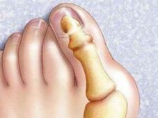 hallux valgus deformity