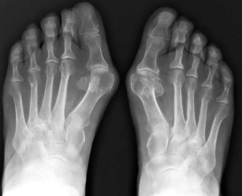 X-ray examination of hallux valgus